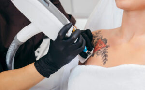 Удаление татуировок неодимовым лазером Nd:YAG.
